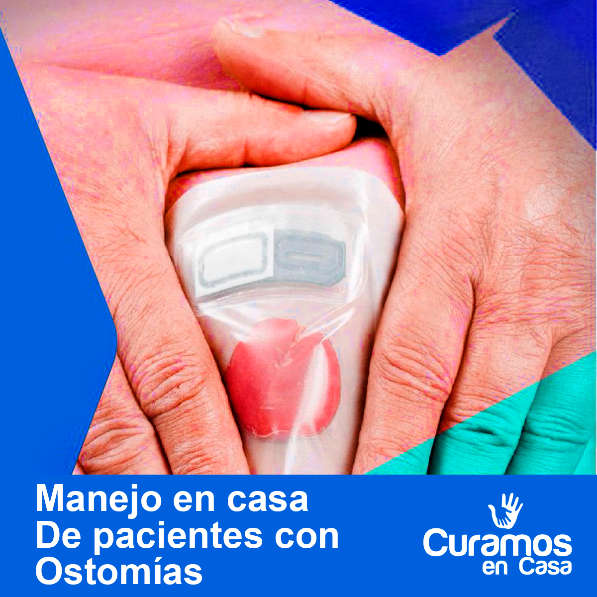 Manejo en casa de pacientes con ostomías