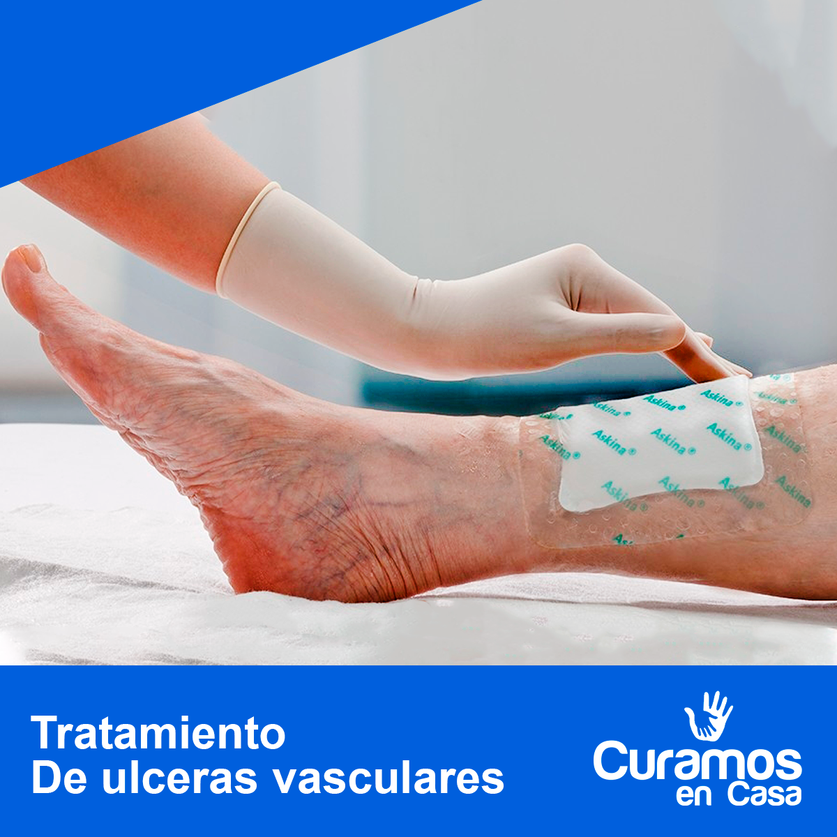 Úlceras venosas