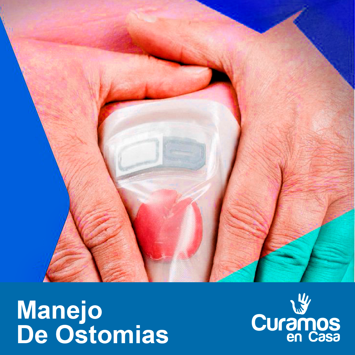 Manejo de ostomías